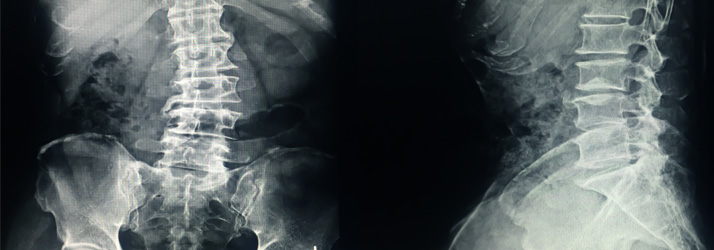 Chiropractic Las Vegas NV Spine X-Ray